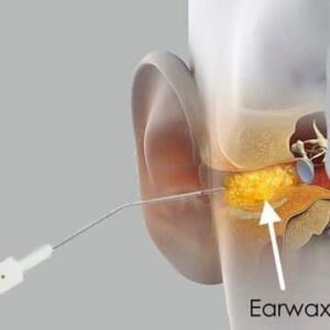 Ear Wax Removal - Both Sides