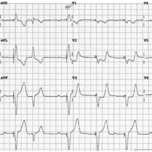 EKG (Electrocardiogram)